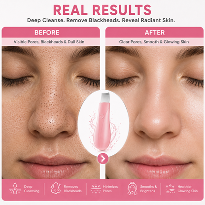 Blackhead Removal, Deep Cleansing, Skin Exfoliation, And Home Skincare